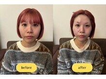 アクアビューティー 金沢(Aqua Beauty)/小顔最新機＊ハイフルウェーブ