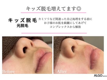 アルゴ 熊本健軍店(ALGO)/キッズ脱毛増えてます◎