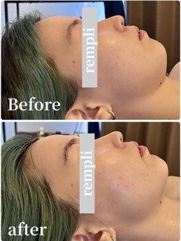 ランプリール 学芸大学(rempli)/最強小顔