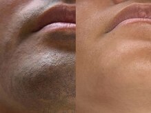 フェリス(FELIZ)/濃いひげの方も大丈夫！