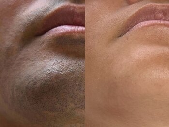 フェリス(FELIZ)/濃いひげの方も大丈夫!