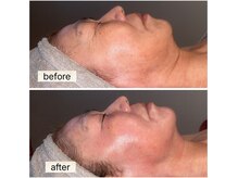 韓国で話題のレモンボトル導入店！たるみ改善お任せください