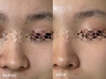 リアルナ(REALUNA)/毛穴/くすみ改善