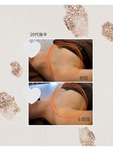 リリー(Lily)/バスト