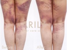 アリリィ(ARILY)/ダウンタイムケア/表参道/外苑前