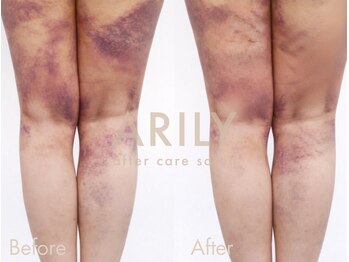 アリリィ(ARILY)/ダウンタイムケア/表参道/外苑前