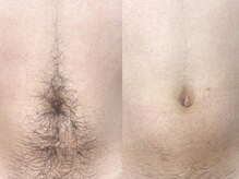 ヴィーヴ 京橋(vive)/【脱毛】お腹周り1回目