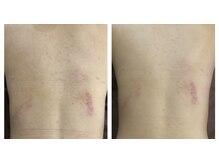 アトリエール(Ateliere)/背中ニキビケアにREVIハーブ