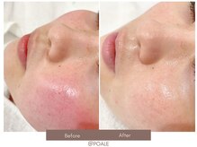 ポアレ 大宮店(POALE)/毛穴ケア症例【埼玉/大宮】