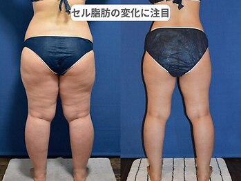 ピュアノア 垂水店/痩身ダイエット 神戸垂水明石