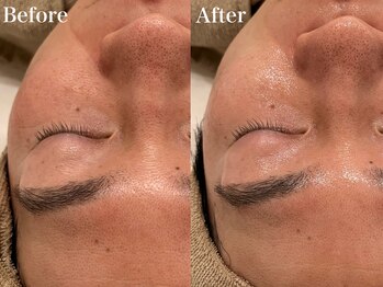 シャルム(Charme)/メンズフェイシャル♪1回の変化