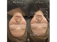 アピュルテ(A purete')の雰囲気（本気の肌質改善×300種類以上の植物幹細胞配合ハーブピーリング）