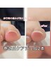 【Foot】巻き爪ケア2本¥12,000(通常¥13,000)