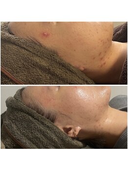 モア(moa)/ハーブピーリング