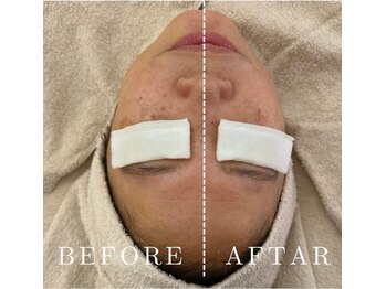 ルシェリア(Le cherien)/小顔リフトアップ