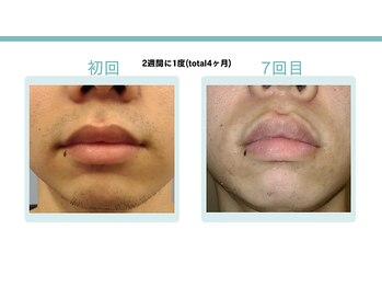 スターポルト(Star-Porte)/ヒゲ脱毛