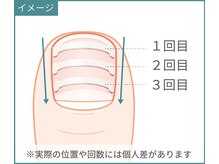 巻き爪研究所 表参道院/爪の付け根まで矯正して再発防止