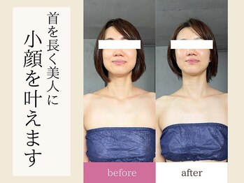 ティアラ/小顔コルギ