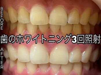 ヴィオール 名古屋栄店(VIOR)/1回で白くなるホワイトニング♪
