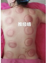 長寿堂 東洋整体院/カッビング痩身