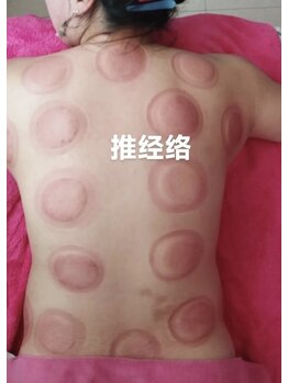 長寿堂 東洋整体院/カッビング痩身