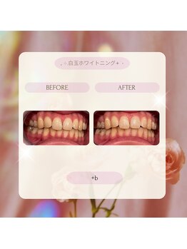 プラスビー 2号店(+b)/ホワイトニングビフォーアフター