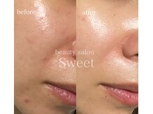 トロイアルケ【ハーブピーリング1回&ホームケア1ケ月】