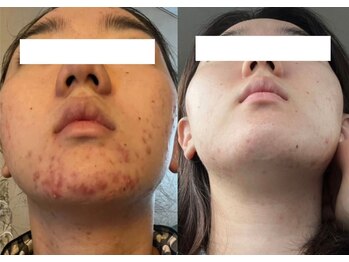 ルポ 那覇(repos)/肌トラブル特化美容鍼100分