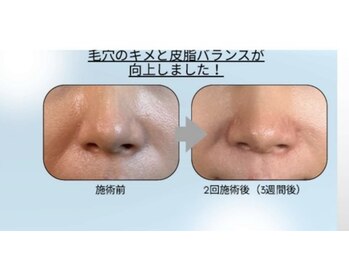 レアハレ(LeaHale)/ダーマフェイシャルでツヤ肌へ