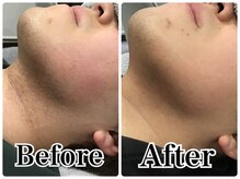 ルリアン(LeLien)/髭脱毛　施術7回の効果！！