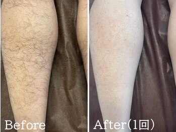 ココモンド(COCOMONDO)/顔脱毛/LED脱毛/エイジングケア