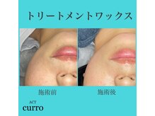 アクト クロ(ACT curro)/【フェイシャル】施術例