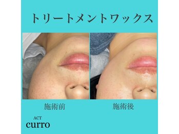 アクト クロ(ACT curro)/【フェイシャル】施術例