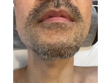 ロイビー(loeyB)/髭脱毛前