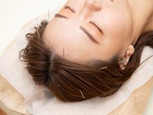 トトノウ(TOTONOU)/眼精疲労にも鍼