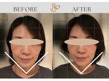 チョコバリ 渋谷店(chocobari)/小顔×リフトアップ(美容鍼)50代