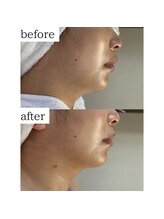 フェリス(FELIZ)/落ちにくいお顔の脂肪はお任せ