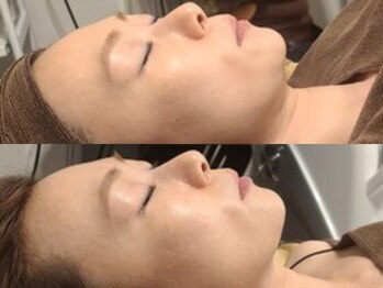 ブラン(BLANC)/【芸能人ピーリング】水光ピール