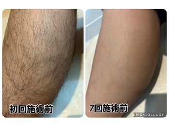 スリーアイ(THREE AI)/◆before→after◆