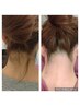 【学割U24】アップヘアも怖くない♪うなじmix脱毛