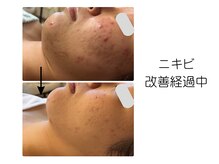 サロン リノ(salon rino)の雰囲気（ニキビ改善の秘密は完全オーダーメイドだから！）