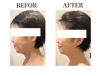 ルアバイアロ(Lua by Alo's)/頬のたるみ改善