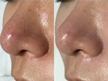 アイリープ(eyeleap)/☆ハイドロ水素毛穴洗浄