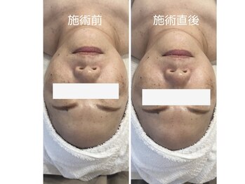 ムー(mu)/光フェイシャル