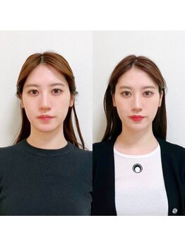 オリノ(Olino)/面長改善！