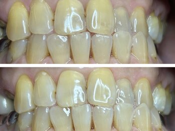 コハク(kohaku)/セルフホワイトニングb/a