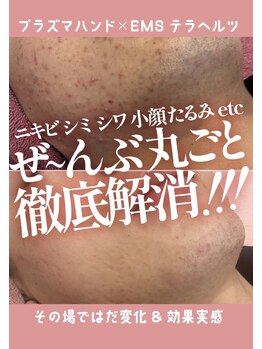 エンネソルミオ(Enne Solmio)/プラズマスターケア☆