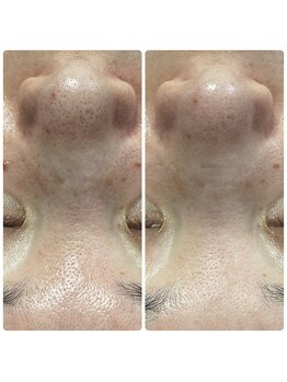 リノ(Lino)/プラズマニア1回で♪