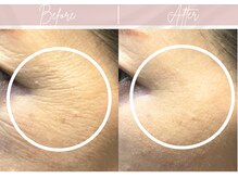 目元キュッとリフトフェイシャル/毛穴/小顔/美白/たるみ改善