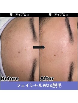 サロンシュシュ(salon Chou Chou)/フェイシャルwax 部分脱毛